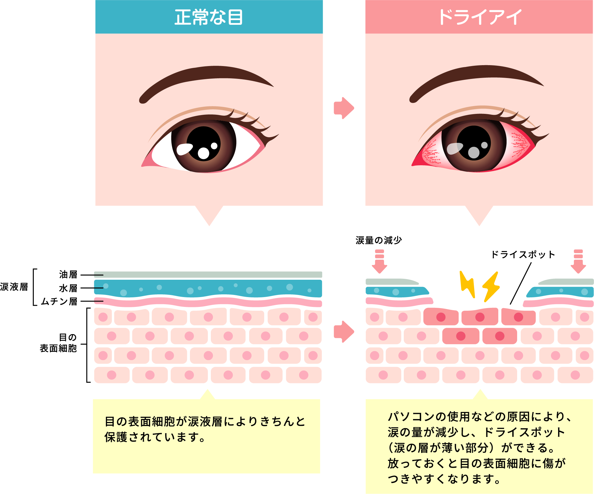 ドライアイのその他の治療法