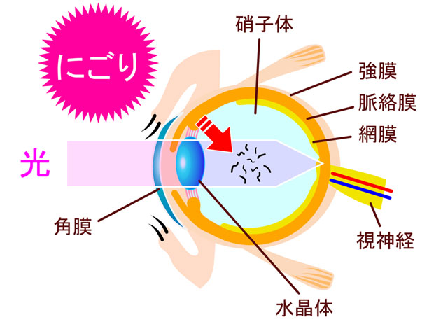 飛蚊症と緑内障の治療選択肢