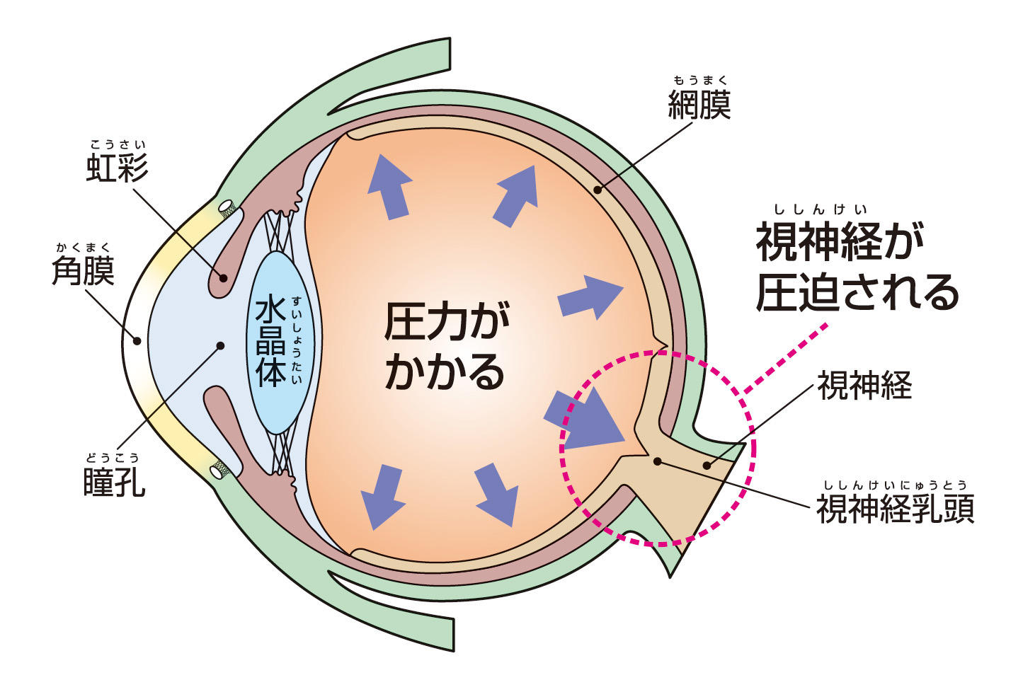閉塞隅角緑内障の予防